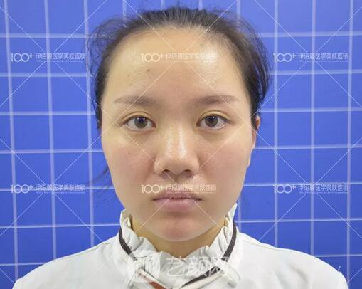 耳軟骨隆鼻術(shù)后一個(gè)月的果，真實(shí)日記一則給大家看看~