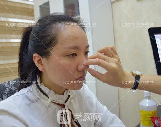 耳軟骨隆鼻術(shù)后一個(gè)月的果，真實(shí)日記一則給大家看看~