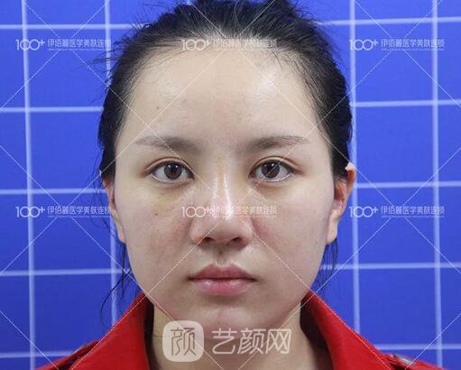 耳軟骨隆鼻術(shù)后一個(gè)月的果，真實(shí)日記一則給大家看看~