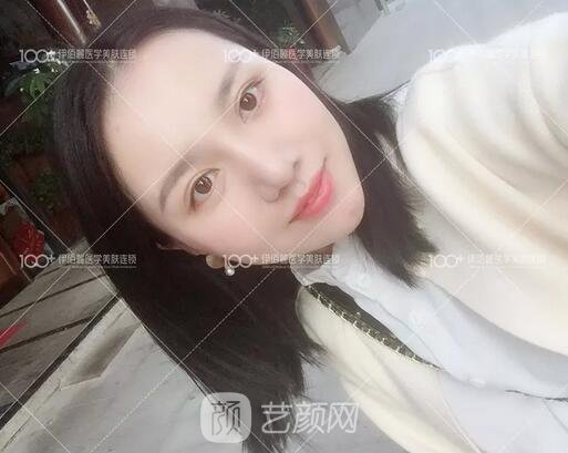 耳軟骨隆鼻術(shù)后一個(gè)月的果，真實(shí)日記一則給大家看看~