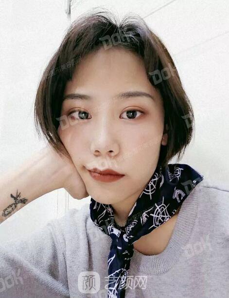 內(nèi)切祛眼袋果怎么樣？來瞧瞧這些照片就可能會有答案了哦~