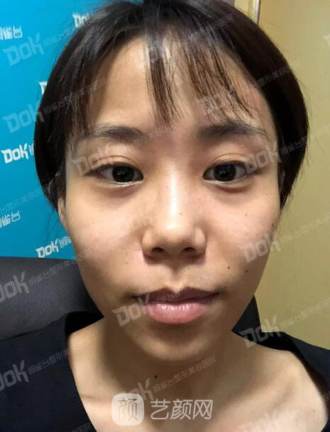 內(nèi)切祛眼袋果怎么樣？來瞧瞧這些照片就可能會有答案了哦~