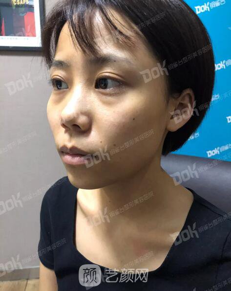 內(nèi)切祛眼袋果怎么樣？來瞧瞧這些照片就可能會有答案了哦~