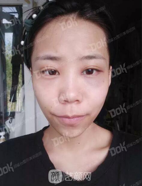 內(nèi)切祛眼袋果怎么樣？來瞧瞧這些照片就可能會有答案了哦~