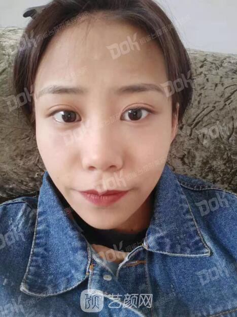 內(nèi)切祛眼袋果怎么樣？來瞧瞧這些照片就可能會有答案了哦~