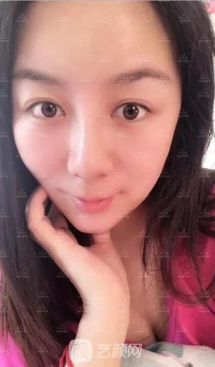 美萊假體隆鼻真實案例