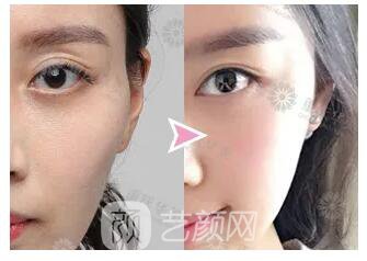 動一動這些部位，臉顯嫩10倍