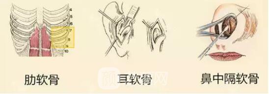 成都大華整形自體軟骨隆鼻要多少錢?