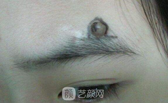 手術(shù)去痣價(jià)格貴不貴