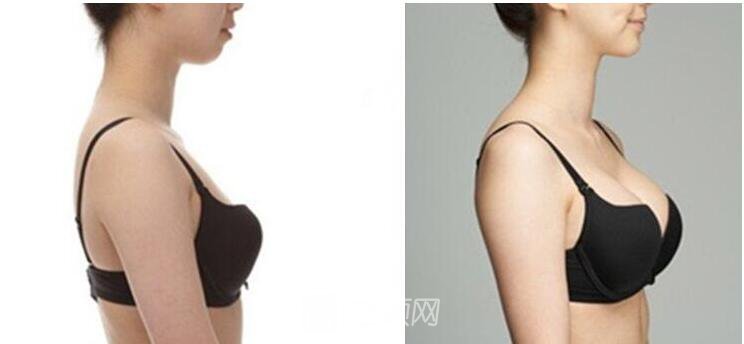 做雪藍(lán)貝假體隆胸能維持多長時間