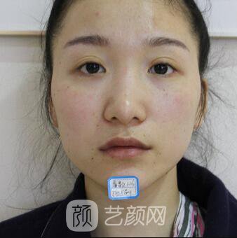 韓式翹鼻-真人案例，直呼我是混血兒