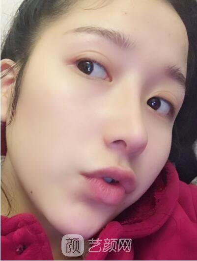 韓式翹鼻-真人案例，直呼我是混血兒