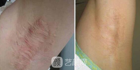 我去做了燒傷疤痕整形手術(shù)，現(xiàn)在已恢復(fù)如此了