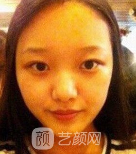 實(shí)拍隆鼻拆線后鼻子恢復(fù)果圖片