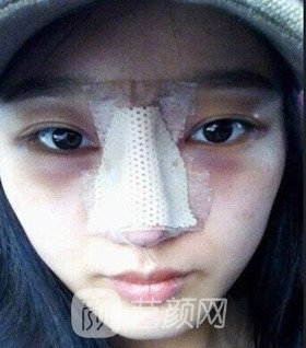 實(shí)拍隆鼻拆線后鼻子恢復(fù)果圖片