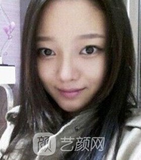 實(shí)拍隆鼻拆線后鼻子恢復(fù)果圖片