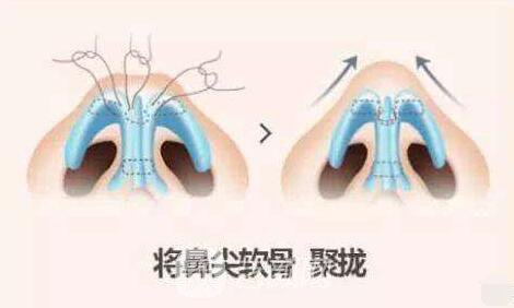 隆鼻果出來了朋友們都說好