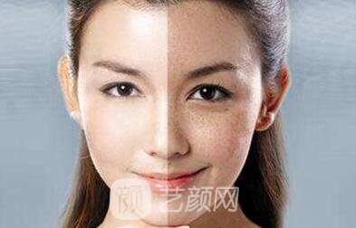 沒有斑 男票再也不會(huì)嫌棄我了