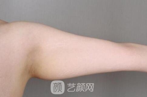 第一次去整形，做了上臂吸脂，自我感覺(jué)果很好哈哈