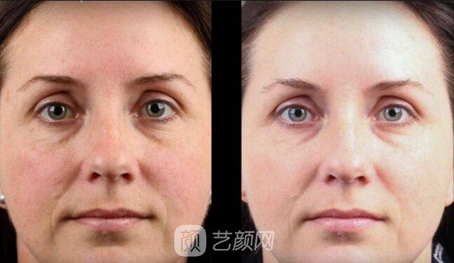 苦惱的遺傳雀斑終于沒了