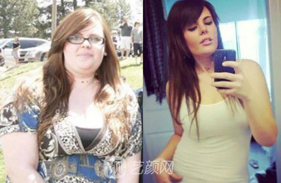 面部吸脂一個月后果圖