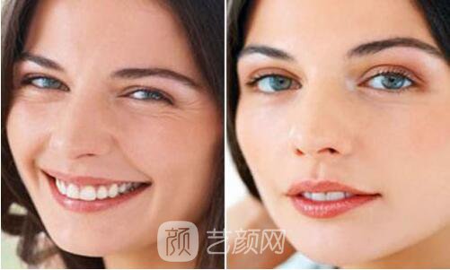 自體脂肪填充童顏術(shù)，讓我也逆生長(zhǎng)了一回