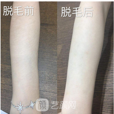 深圳翠綠寶石激光脫毛如何？我們一起來了解一下