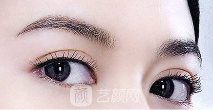 雙眼皮兩個月，是這個樣子的，大家來看看