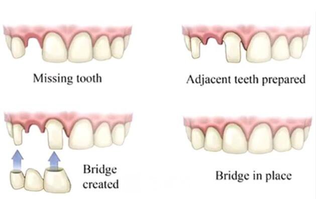 做容冠，牙齒整齊又漂亮~