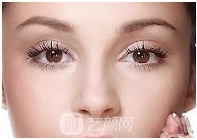 做完雙眼皮兩個月，簡直跟換了個人似的