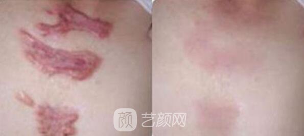 杭州激光去疤費(fèi)用，多久見