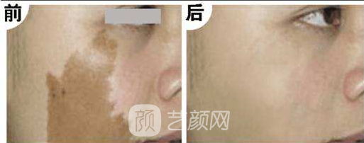 湖南激光祛斑好嗎？