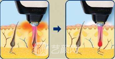 蘭州醫(yī)院激光脫毛多少錢