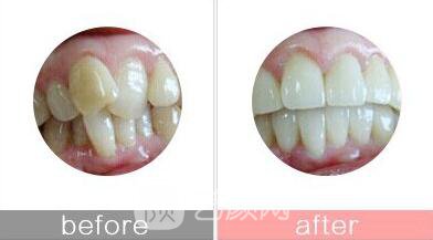 宜昌市矯正牙齒多少錢?矯正果如何?