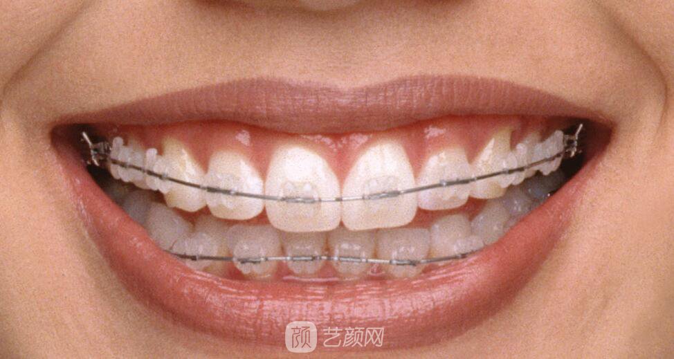 宜昌市矯正牙齒多少錢?矯正果如何?