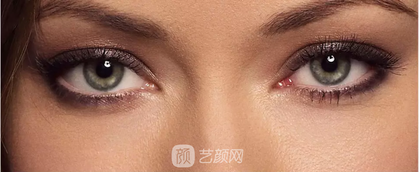 開眼角專家解答開眼角有哪些好處