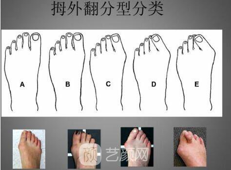 去大腳骨的醫(yī)院金華有嗎?