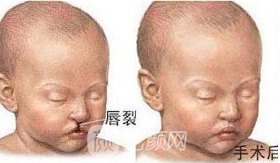 泉州哪里有做唇裂的醫(yī)院