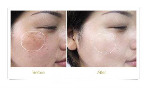 深圳金華城激光去疤多少錢