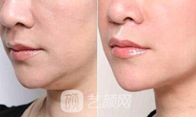 上海溶脂價格為什么沒有統(tǒng)一，當?shù)爻錾t(yī)生為你解答