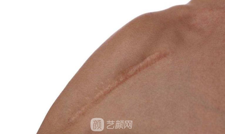 疤痕修復;還原您平整光滑肌膚!