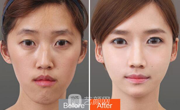 看我的韓式鼻子整形對(duì)照?qǐng)D，前后差距是否很大