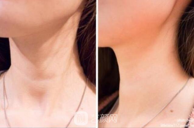 面部美容去皺果怎樣?請看真人案例