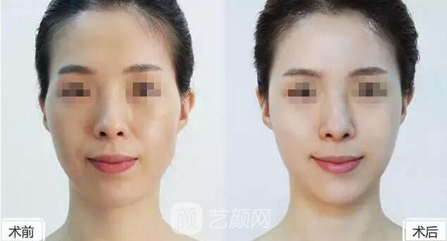 玻尿酸到底是什么東西，小編為你解剖分析