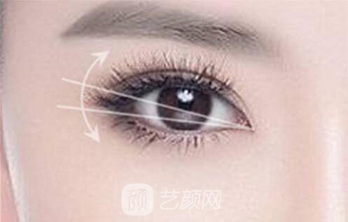 韓式切開雙眼皮的真實過程及恢復體驗分享~~