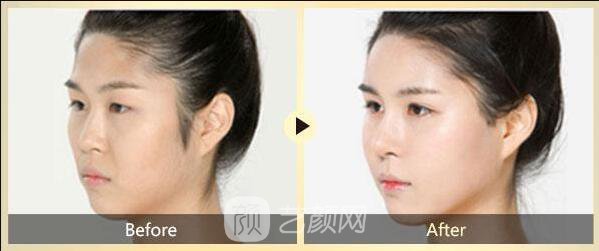 面部去皺術有很多，選適合自己的才是王道