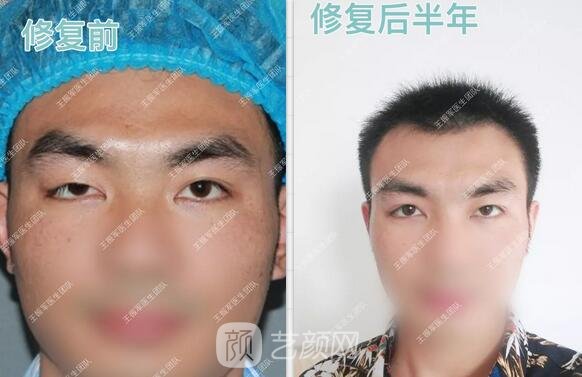 雙眼皮上瞼下垂矯正術