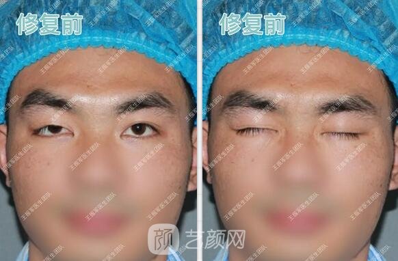 雙眼皮手術案例術后果