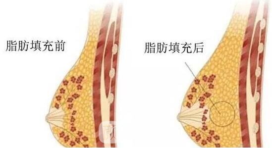 自體脂肪填充隆胸手術