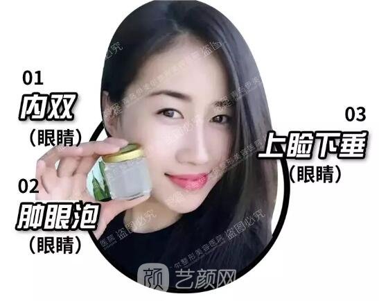 雙眼皮手術(shù)前照片